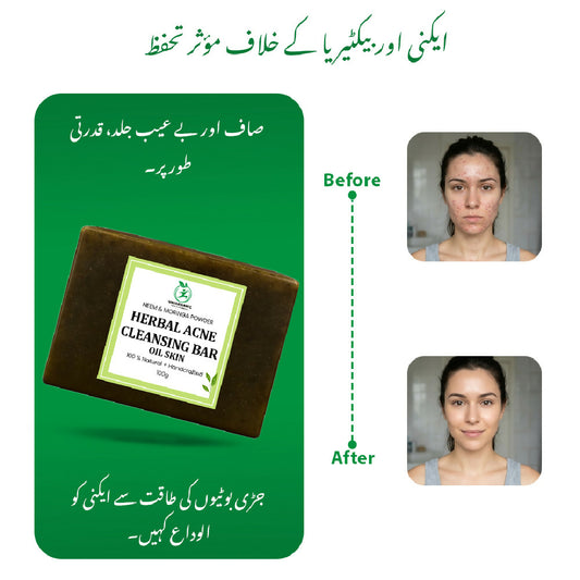HARBAL ACNE SOAP