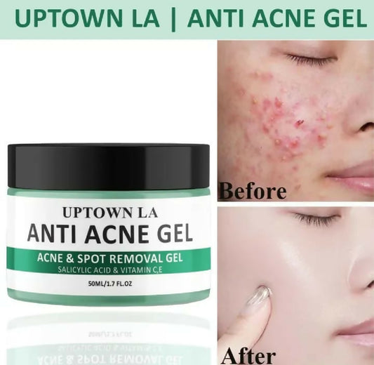Uptown LA Anti Acne Gel For Face Oil Control Acne Treatment Clear Smooth Healthy Skin Care
