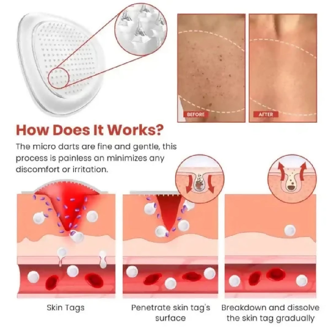 DermaSmooth Skin Tag Remover Patch - Fast Safe and Painless Skin Tag and Mole Removal Solution